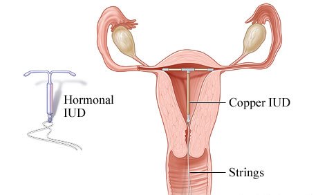 Insertion side effects after iud IUD side